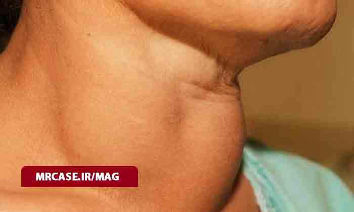 گواتر چیست ؟ علائم و روش های درمان
