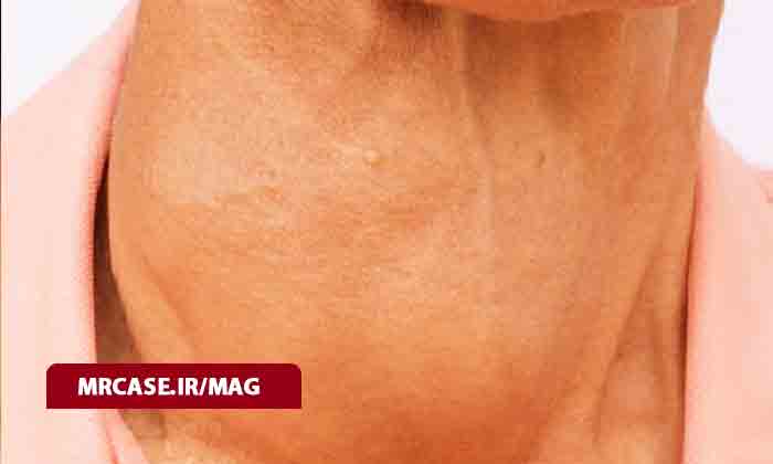 چه چیزی مبتلا شدن به گواتر را زیاد می کند