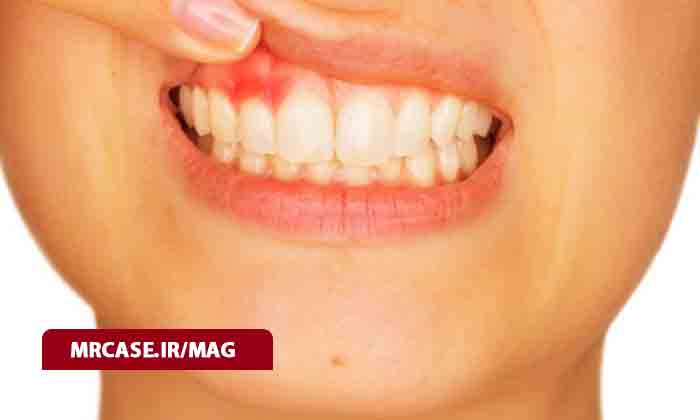 علائم التهاب لثه