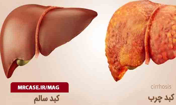 غذاهایی که برای کبد ضرر دارند