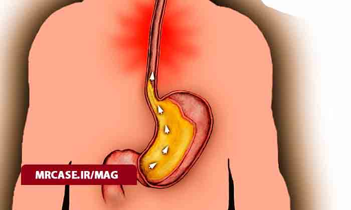 رفلاکس معده