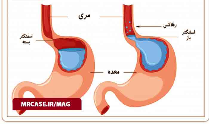 روش های پیشگیری از رفلاکس معده