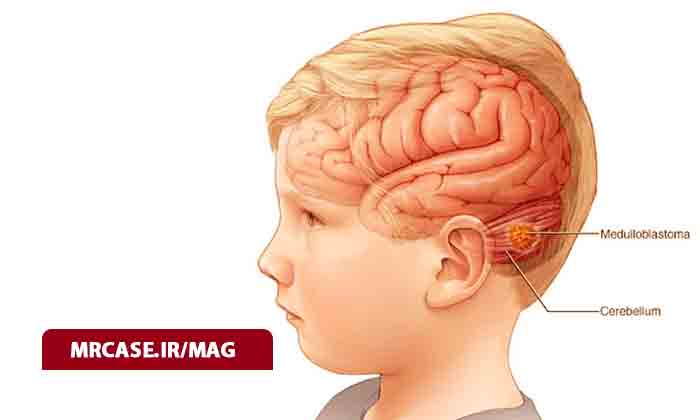 بیماری مغزی مدولوبلاستوما چیست؟