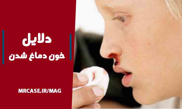 علت خون دماغ شدن چیست