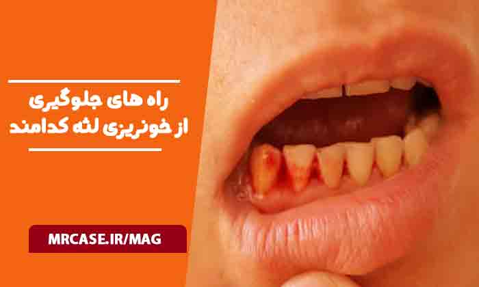راه های جلوگیری از خونریزی لثه کدامند؟