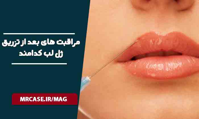 مراقبت های بعد از تزریق ژل لب کدامند؟