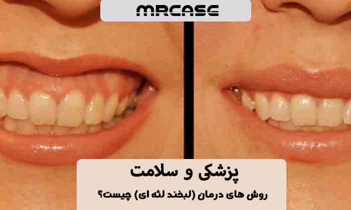روش های درمان گامی اسمایل (لبخند لثه ای) چیست؟